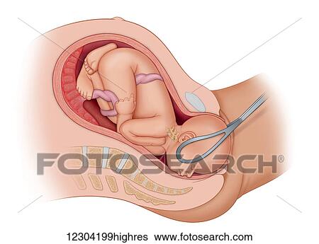 Cross section of the mother's anatomy showing the baby in uteruo LOA being delivered normally via the use of forceps turning head from Loa to Oa for normal delivery View Large Photo Image Stock Photograph - Cross section of the mother's anatomy showing the baby in uteruo LOA being delivered normally via the use of forceps turning head from Loa to Oa for normal delivery. Fotosearch