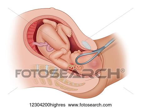 Cross section of the mother's anatomy showing the baby OP in uteruo being delivered by forceps, turning baby's head from Rop to OP. Because the baby is in the incorrect position for delivery, the baby's neck is being pulled in the wrong direction... View Large Photo Image Stock Photograph - Cross section of the mother's anatomy showing the baby OP in uteruo being delivered by forceps, turning baby's head from Rop to OP. Because the baby is in the incorrect position for delivery, the baby's neck is being pulled in the wrong direction.... Fotosearch