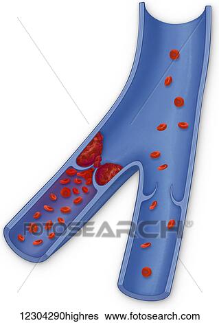Stock Photograph - Deep vein thrombus. Fotosearch
