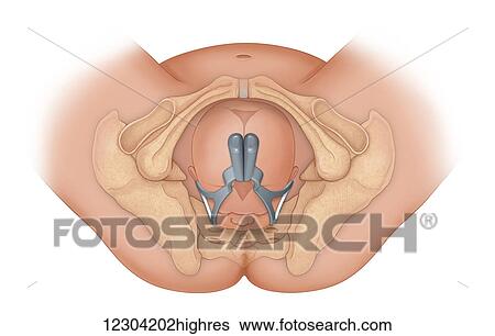 Stock Photograph - Doctor's view of a baby in occiptital anterior position being delivered by proper use of forceps. Fotosearch
