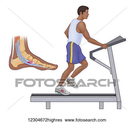 Stock Photograph - Foot injury from running on the treadmill. Fotosearch