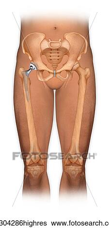 Stock Photograph - Front view of a body showing a total hip replacement. Fotosearch