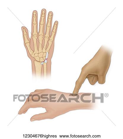 Hand bones with injury and finger pointing to wrist View Large Photo Image Stock Photograph - Hand bones with injury and finger pointing to wrist. Fotosearch