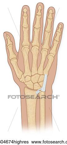 Hand bones with injury View Large Photo Image Stock Photograph - Hand bones with injury. Fotosearch