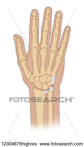 Hand bones with injury View Large Photo Image Stock Photograph - Hand bones with injury. Fotosearch