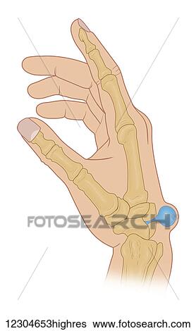 Illustration of dorsal wrist Ganglion cyst View Large Photo Image Stock Photograph - Illustration of dorsal wrist Ganglion cyst. Fotosearch