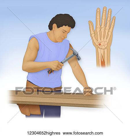 Illustration of the FlexorCarpi Radialis Tendinitis, caused by repetitive trauma such as prolonged use of a heavy hammer View Large Photo Image Stock Photograph - Illustration of the FlexorCarpi Radialis Tendinitis, caused by repetitive trauma such as prolonged use of a heavy hammer. Fotosearch