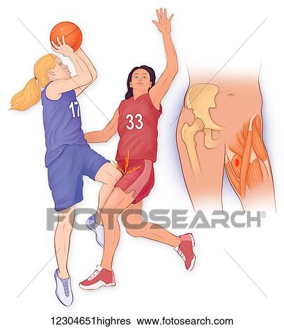 Stock Photograph - Illustration of the iliopectineal bursa, vulnerable to injury from both acute and repeated trauma to the bursa and surrounding area. Fotosearch