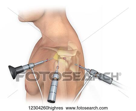 Stock Photograph - Lateral view of arthroscopic surgical repair on the shoulder joint. Fotosearch
