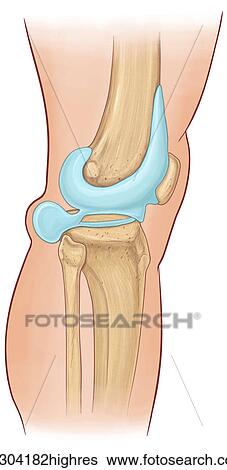 Stock Photograph - Lateral view of Baker's Cyst. Fotosearch