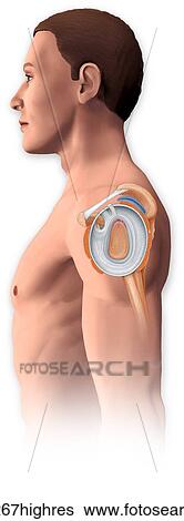 Lateral view of the shoulder joint showing the repair to the torn labrum View Large Photo Image Stock Photograph - Lateral view of the shoulder joint showing the repair to the torn labrum. Fotosearch