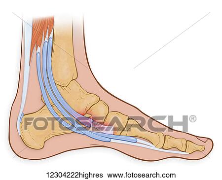Medial view of the foot showing inflamed and frayed tibialis posterior tendon View Large Photo Image Stock Photograph - Medial view of the foot showing inflamed and frayed tibialis posterior tendon. Fotosearch