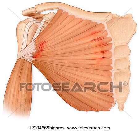 Stock Photograph - Microscopic muscle fiber tears of the pectoralis major muscle, also called Pectoralis Major Tear Syndrome. Fotosearch
