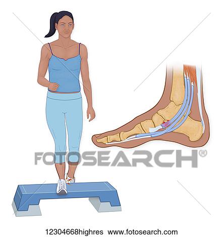 Stock Photograph - Os Trigonum Pain Syndrome is associated with high impact force or activites on the foot. Fotosearch