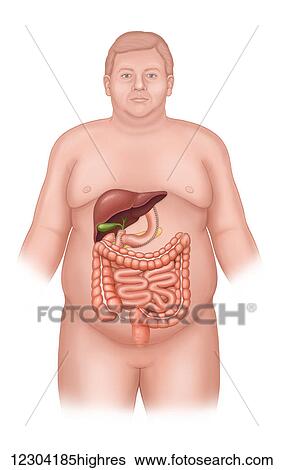 Post bilio pancreatic diversion surgery and abdominal organs View Large Photo Image Stock Photograph - Post bilio pancreatic diversion surgery and abdominal organs. Fotosearch