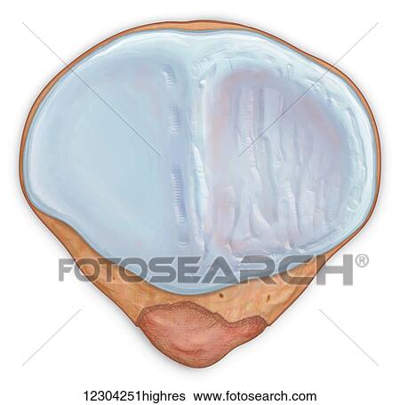 Stock Photograph - Posterior view patellar surface showing and injured cartilage surface. Fotosearch