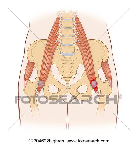 Stock Photograph - Repetitive activities like aerobics that involve lifting up the knee can cause trauma to the iliopectinate bursa, lead to iliopectinate bursitis. Fotosearch
