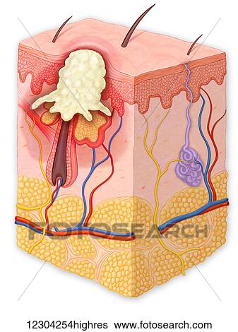 Skin cross section showing a pustule View Large Photo Image Stock Photograph - Skin cross section showing a pustule. Fotosearch