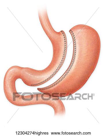 Stock Photograph - Sleeve gastrectomy procedure. Fotosearch