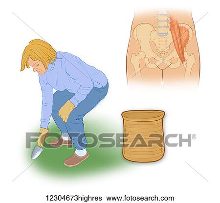 Stock Photograph - Snapping hip syndrome is the result of the iliopsoas tendon subluxing over the greater trochanter or ilopectineal eminence. The symptoms most commonly occur when rising from a sitting to a standing position or walking briskly.. Fotosearch