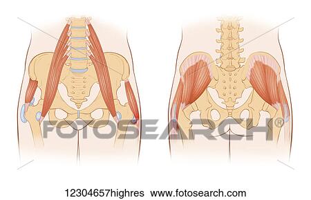 Stock Photograph - Snapping hip syndrome occurs when the iliopsoas tendon subluxes over the greater trochanter or iliopectinate eminence. Frequently found with people with arthritis of the hip. Fotosearch