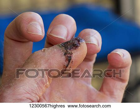 Stock Photograph - Thumb injury. Fotosearch