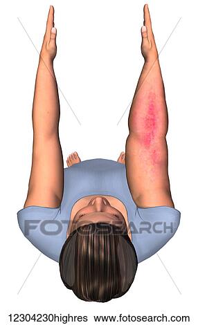 Top view of a woman showing a normal arm versus an arm with Lymphedema View Large Photo Image Stock Photograph - Top view of a woman showing a normal arm versus an arm with Lymphedema. Fotosearch