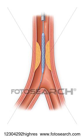 Stock Photograph - Vessel occluded with plaque with stent in place. Fotosearch