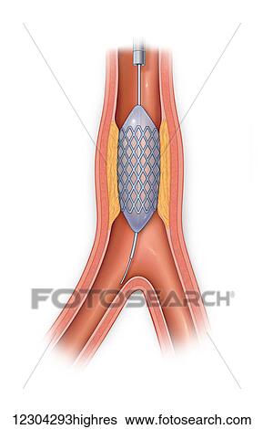 Stock Photograph - Vessel occluded with plaque with stent in place and balloon inflated. Fotosearch