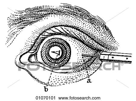 Clip Art - Science & Medicine - line art (Medical) A 19th century illustration Operation. Fotosearch