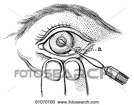 Clipart - Science & Medicine - line art (Medical) A 19th century illustration Operation. Fotosearch