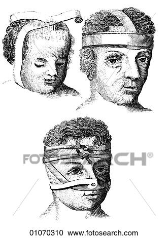 Clipart - Science & Medicine - line art (Medical) Bandages Illustration from Heister`s Surgery Heister`s Surgery is an 18th century medical text published in 1743, the year Thomas Jefferson was born. It was billed as a "General system of surgery in three parts.. Fotosearch