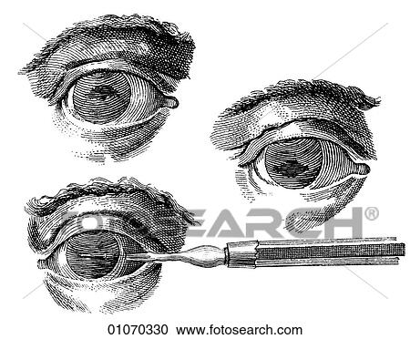 Science & Medicine - line art (Medical) Eye Medical Procedure Illustration from Heister`s Surgery Heister`s Surgery is an 18th century medical text published in 1743, the year Thomas Jefferson was born. It was billed as a "General system of surgery in View Large Illustration Clipart - Science & Medicine - line art (Medical) Eye Medical Procedure Illustration from Heister`s Surgery Heister`s Surgery is an 18th century medical text published in 1743, the year Thomas Jefferson was born. It was billed as a "General system of surgery in. Fotosearch