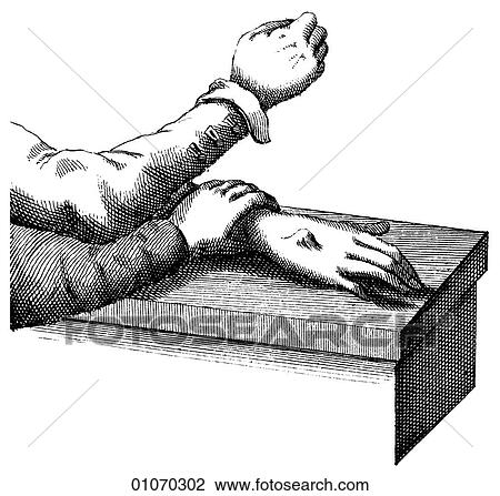Drawing - Science & Medicine - line art (Medical) Medical Procedure Illustration from Heister`s Surgery Heister`s Surgery is an 18th century medical text published in 1743, the year Thomas Jefferson was born. It was billed as a "General system of surgery in thre. Fotosearch