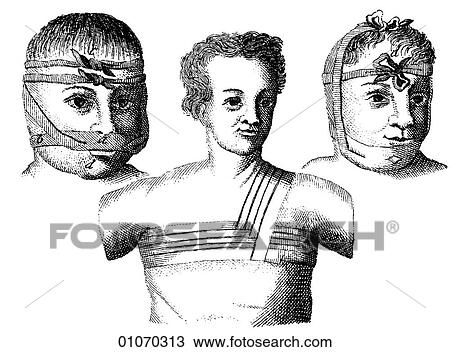 Drawing - Science & Medicine - line art (Medical) Bandages Illustration from Heister`s Surgery Heister`s Surgery is an 18th century medical text published in 1743, the year Thomas Jefferson was born. It was billed as a "General system of surgery in three parts.. Fotosearch