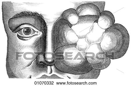 Science & Medicine - line art (Medical) Eye Disorder Illustration from Heister`s Surgery Heister`s Surgery is an 18th century medical text published in 1743, the year Thomas Jefferson was born. It was billed as a "General system of surgery in three pa View Large Illustration Drawing - Science & Medicine - line art (Medical) Eye Disorder Illustration from Heister`s Surgery Heister`s Surgery is an 18th century medical text published in 1743, the year Thomas Jefferson was born. It was billed as a "General system of surgery in three pa. Fotosearch