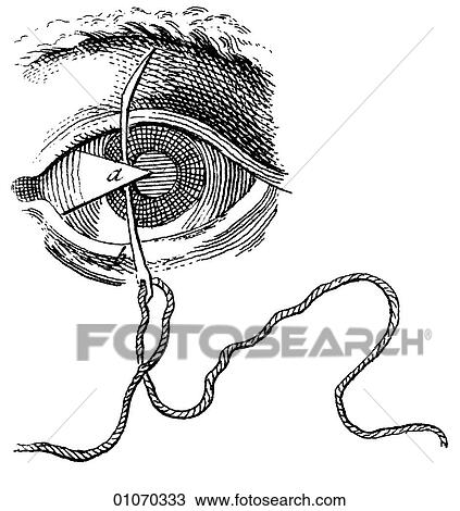 Science & Medicine - line art (Medical) Heister`s Surgery Eye Disorder, Surgical technique Illustration from Heister`s Surgery Heister`s Surgery is an 18th century medical text published in 1743, the year Thomas Jefferson was born. It was billed as a " View Large Illustration Drawing - Science & Medicine - line art (Medical) Heister`s Surgery Eye Disorder, Surgical technique Illustration from Heister`s Surgery Heister`s Surgery is an 18th century medical text published in 1743, the year Thomas Jefferson was born. It was billed as a ". Fotosearch