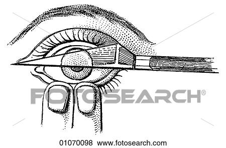 Stock Illustration - Science & Medicine - line art (Medical) A 19th century illustration Operation. Fotosearch
