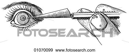 Stock Illustration - Science & Medicine - line art (Medical) A 19th century illustration Operation. Fotosearch