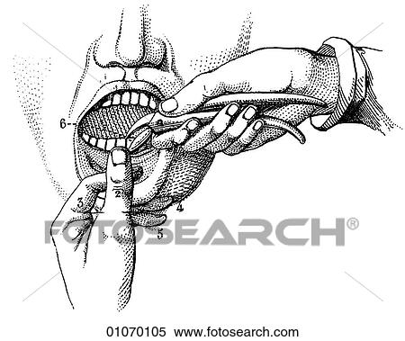 Science & Medicine - line art (Medical) 19th century surgical illustration Oral surgery View Large Illustration Stock Illustration - Science & Medicine - line art (Medical) 19th century surgical illustration Oral surgery. Fotosearch