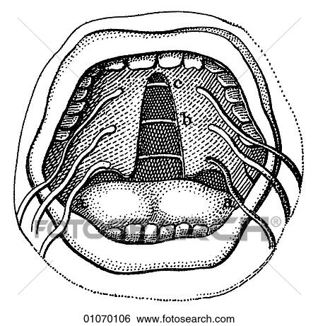 Stock Illustration - Science & Medicine - line art (Medical) 19th century surgical illustration Oral surgery. Fotosearch