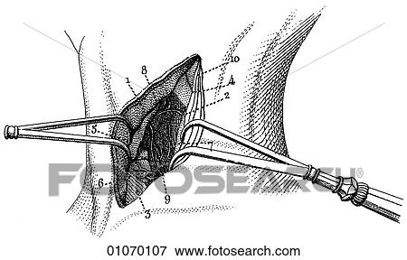 Stock Illustration - Science & Medicine - line art (Medical) An 18th century surgical illustration operation. Fotosearch