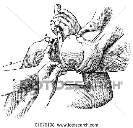 Stock Illustration - Science & Medicine - line art (Medical) 19th century surgical illustration Operation. Fotosearch