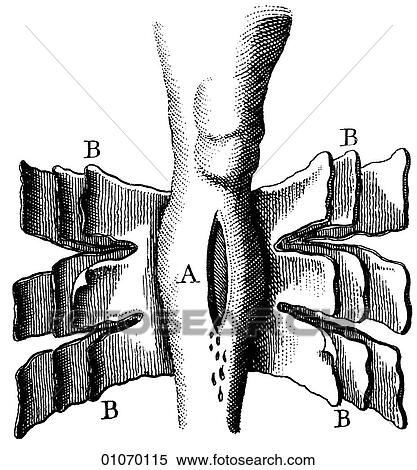 Stock Illustration - Science & Medicine - line art (Medical) Fractures of the Bone Bandages Illustration from Heister`s Surgery Heister`s Surgery is an 18th century medical text published in 1743, the year Thomas Jefferson was born. It was billed as a "General system of su. Fotosearch