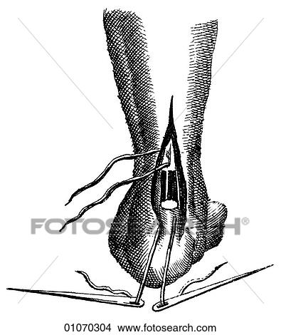 Stock Illustration - Science & Medicine - line art (Medical) Medical Procedure Illustration from Heister`s Surgery Heister`s Surgery is an 18th century medical text published in 1743, the year Thomas Jefferson was born. It was billed as a "General system of surgery in thre. Fotosearch