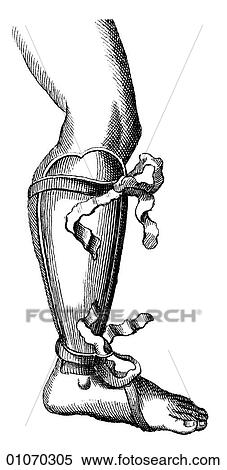 Stock Illustration - Science & Medicine - line art (Medical) Medical Procedure Illustration from Heister`s Surgery Heister`s Surgery is an 18th century medical text published in 1743, the year Thomas Jefferson was born. It was billed as a "General system of surgery in thre. Fotosearch