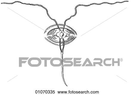 Science & Medicine - line art (Medical) Eye Disorder - surgical technique Illustration from Heister`s Surgery Heister`s Surgery is an 18th century medical text published in 1743, the year Thomas Jefferson was born. It was billed as a "General system of View Large Illustration Stock Illustration - Science & Medicine - line art (Medical) Eye Disorder - surgical technique Illustration from Heister`s Surgery Heister`s Surgery is an 18th century medical text published in 1743, the year Thomas Jefferson was born. It was billed as a "General system of. Fotosearch