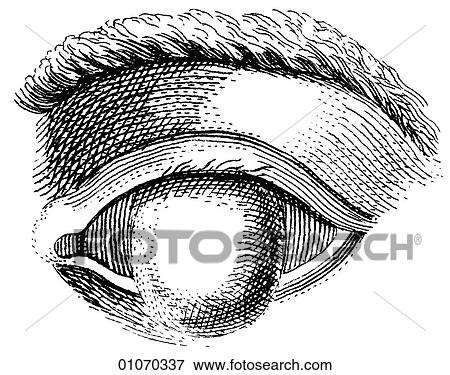 Science & Medicine - line art (Medical) Heister`s Surgery Eye Disorder Illustration from Heister`s Surgery Heister`s Surgery is an 18th century medical text published in 1743, the year Thomas Jefferson was born. It was billed as a "General system of su View Large Illustration Stock Illustration - Science & Medicine - line art (Medical) Heister`s Surgery Eye Disorder Illustration from Heister`s Surgery Heister`s Surgery is an 18th century medical text published in 1743, the year Thomas Jefferson was born. It was billed as a "General system of su. Fotosearch