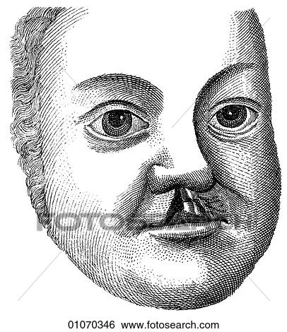 Stock Illustration - Science & Medicine - line art (Medical) Medical Procedures Oral surgery Illustration from Heister`s Surgery Heister`s Surgery is an 18th century medical text published in 1743, the year Thomas Jefferson was born. It was billed as a "General system of s. Fotosearch