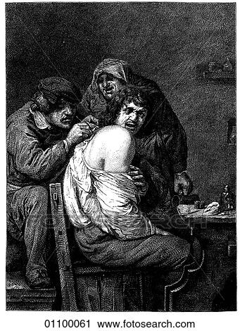 Paintings & Engravings - Engraving - Belgium "A Surgical Operation" by Adriaen Brouwer (1605-1638) Brouwer studied under Frans Hals and most of his paintings, save for a few late landscapes, are of peasant life and everyday scenes. He was once impriso View Large Illustration Clip Art - Paintings & Engravings - Engraving - Belgium "A Surgical Operation" by Adriaen Brouwer (1605-1638) Brouwer studied under Frans Hals and most of his paintings, save for a few late landscapes, are of peasant life and everyday scenes. He was once impriso. Fotosearch